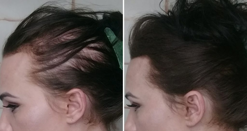 دلایل ریزش مو در زنان و بهترین روش درمان آن